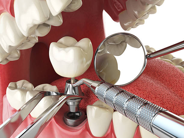 Best Emergency Dental Care for Broken or Chipped Teeth in Brewster Hill, NY